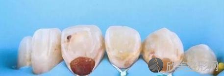 牙齿缺损如何修复？
