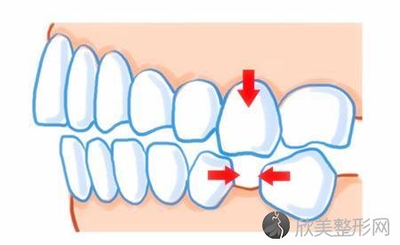 牙齿缺失的危害以及修复方法有哪些？