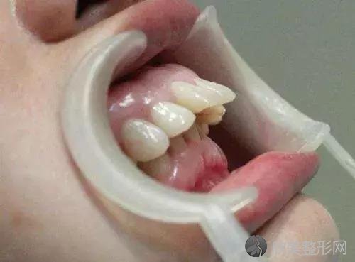 只是简单的龅牙？你不知道的三种龅牙类型！