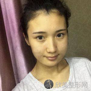 北大崔永言取生长因子怎么样?水光针术前术后图