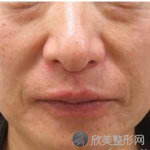 北京304陈敏亮主任怎么样?注射术前术后图