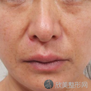 北京304陈敏亮主任怎么样?注射术前术后图
