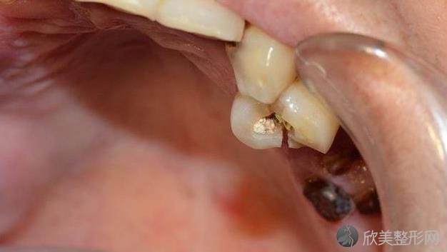 牙齿酸痛到底怎么回事？