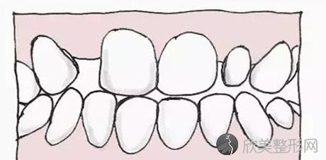 牙齿不齐的表现是什么？有什么危害？