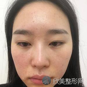 北京304医院陈敏亮疤痕怎么样?祛痘价格表-术前术后图