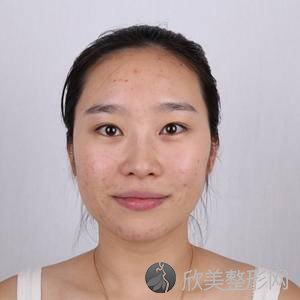 北京304医院陈敏亮疤痕怎么样?祛痘价格表-术前术后图