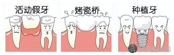 哪种假牙好？选择假牙你需要知道些什么？