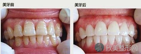讨厌的氟斑牙是怎样长成的？又该怎样去除？