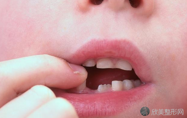 孩子牙齿会发黑是龋齿吗？龋齿会传染吗？
