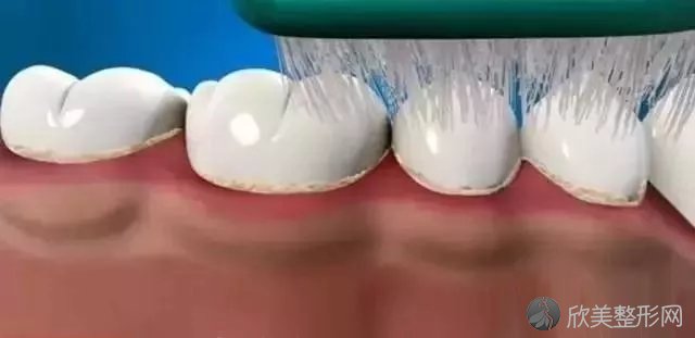 牙龈红肿、口臭？针对牙周炎，牙医都推荐龈下刮治！