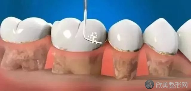 牙龈红肿、口臭？针对牙周炎，牙医都推荐龈下刮治！