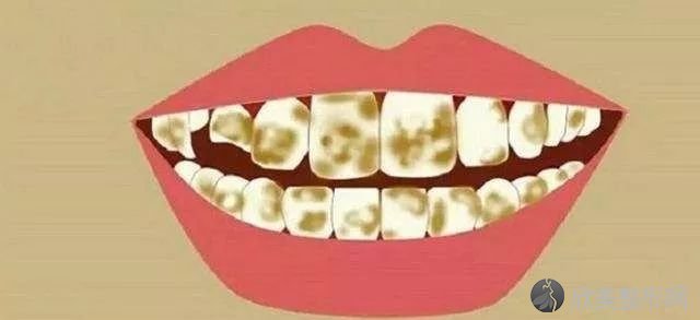 牙齿为什么会变黄？常用的美白方式了解一下！