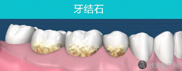 软垢与牙石的形成过程！