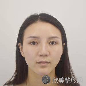 北京八大处范飞鼻再造案例怎么样?双眼皮修复案例和价格同步分享！