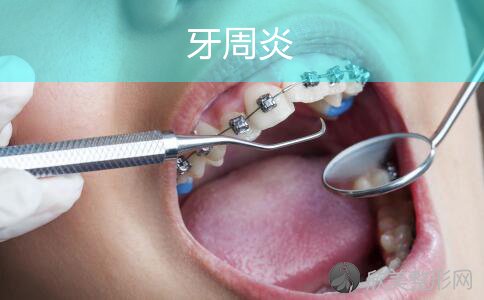 牙周炎和蛀牙有什么关系？