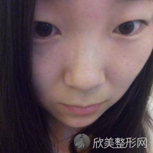 北京东方和谐冯斌吸脂好吗?光子嫩肤价格表-术前术后图