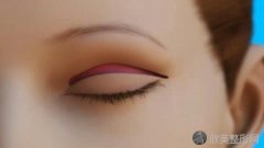 疤痕体质可以做双眼皮手术吗？