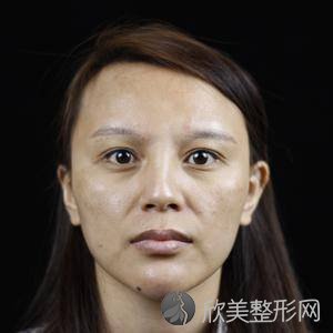 北京华韩柳民熙面部提升做得好吗?自体脂肪填充三个月术前术后图-价格表