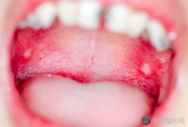 口里总是爱长泡，可能口腔“惹恼”了5种疾病，别大意！