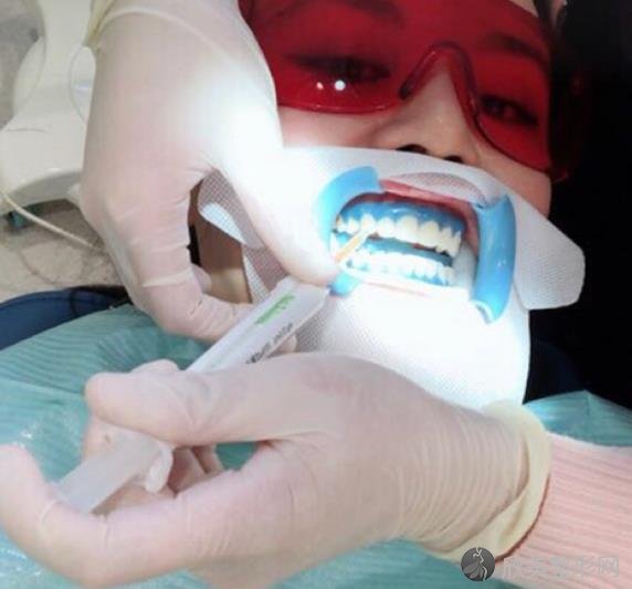 自锁牙套和普通牙套的区别图片，了解两种牙套区别！