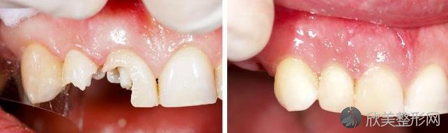 意外把牙齿磕掉了一点，缺损后该怎么修复？别急，听听牙医的建议！