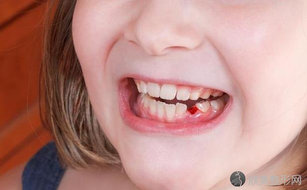 孩子的牙齿如何护理？这3个步骤，家长要让孩子做到！
