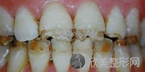 专家详解氟斑牙：症状、危害以及如何治疗？