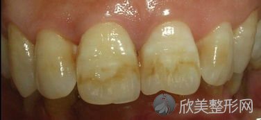 专家详解氟斑牙：症状、危害以及如何治疗？
