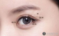 眼部重睑术的方法有哪几种