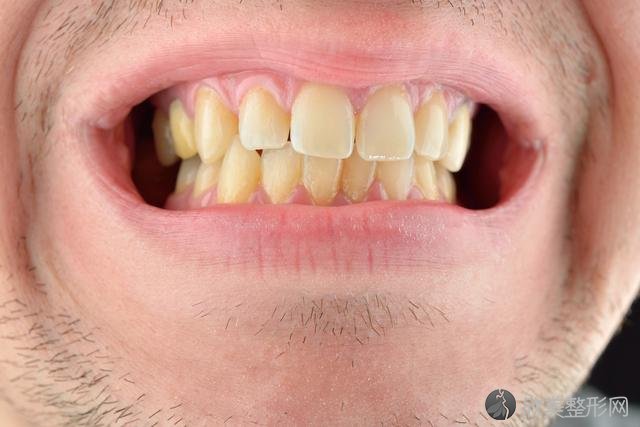 不想一辈子长着氟斑牙，冷光美白技术有用吗？几个关键点要注意！