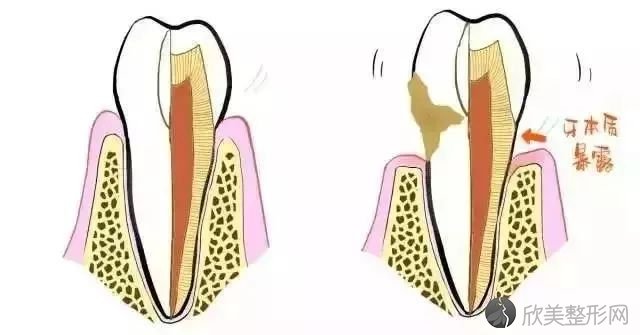 洗牙后牙齿敏感怎么办？?