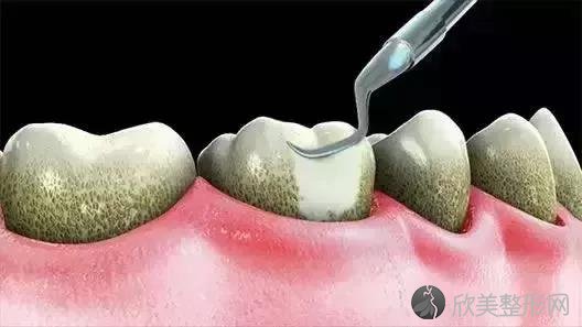 洗牙后牙齿敏感怎么办？?