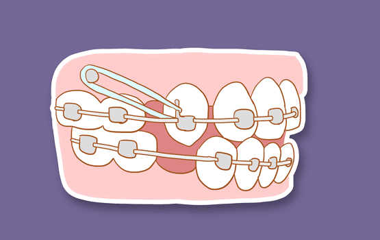 同样用于牙齿正畸，骨钉和附件有什么区别？