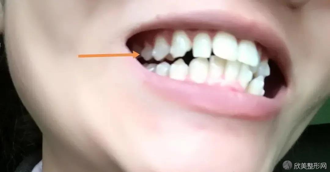 同样用于牙齿正畸，骨钉和附件有什么区别？