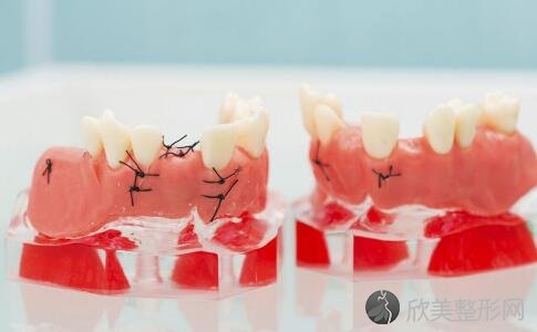 牙龈炎的治疗和护理方法是什么？