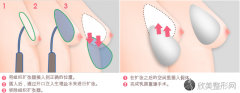 乳房再造术有哪些优势？术后的几个优点