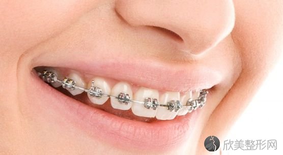 矫正牙齿有哪些利与弊？