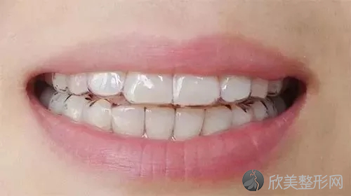 矫正牙齿有哪些利与弊？