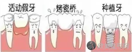 牙齿缺失了到底怎么办？