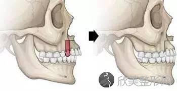 如何识别自己是牙性龅牙还与骨性龅牙？