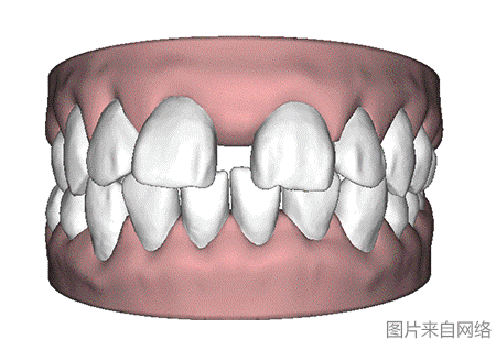 如何识别自己是牙性龅牙还与骨性龅牙？