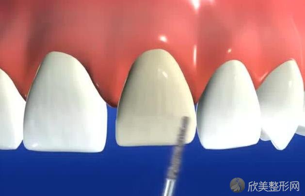 烤瓷牙、牙贴面都可以修复牙齿！选哪种好？听听牙医的真建议！