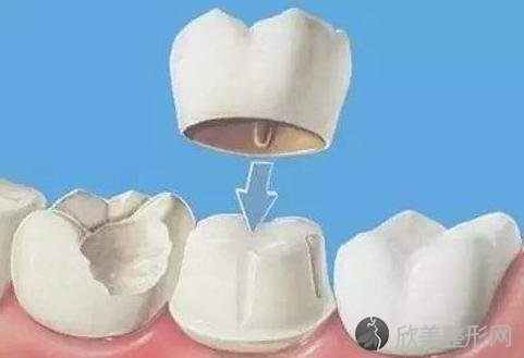 烤瓷牙、牙贴面都可以修复牙齿！选哪种好？听听牙医的真建议！