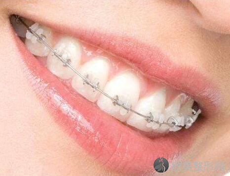 牙齿正畸的十大作用，三十岁牙齿正畸有必要吗？