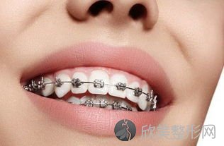 牙齿正畸的十大作用，三十岁牙齿正畸有必要吗？