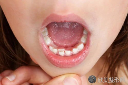 为什么牙齿长得不齐，原因是什么？