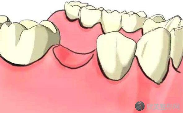 牙齿缺失了，通过牙齿矫正来修复更好？惊人！先听听看牙医怎么说.