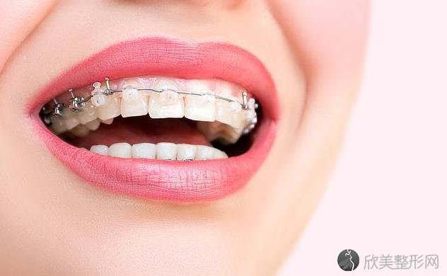 牙齿矫正后需要注意些什么？这4点，不能忽略了！