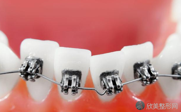 牙齿矫正之后为什么会反弹？快看看是不是这4个原因！