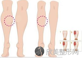 小腿吸脂术前术后的一些注意事项